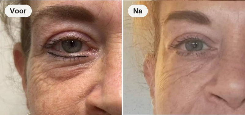 Ooggebied voor en na